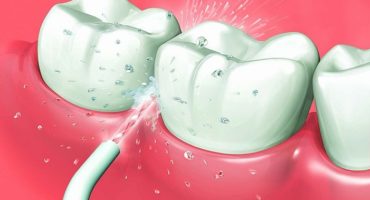 Irigator oral - care este mai bine să alegeți și de ce aveți nevoie